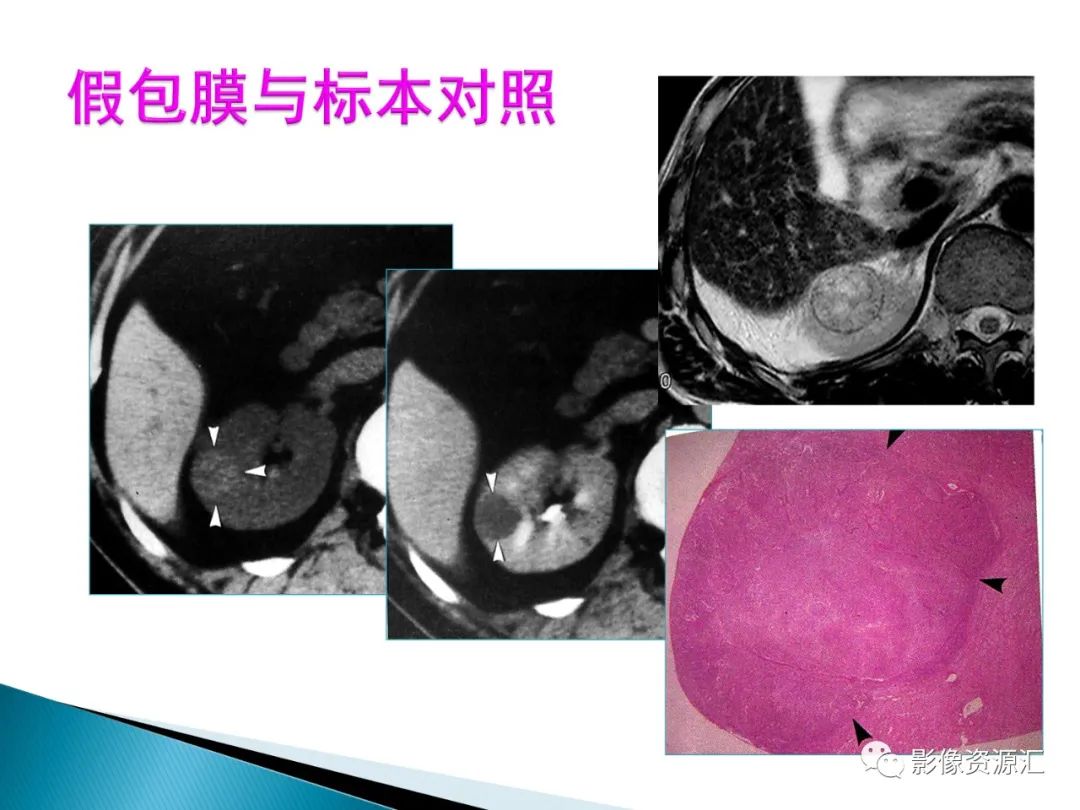 影像PPT - 【PPT】肾癌的CT MRI诊断-60