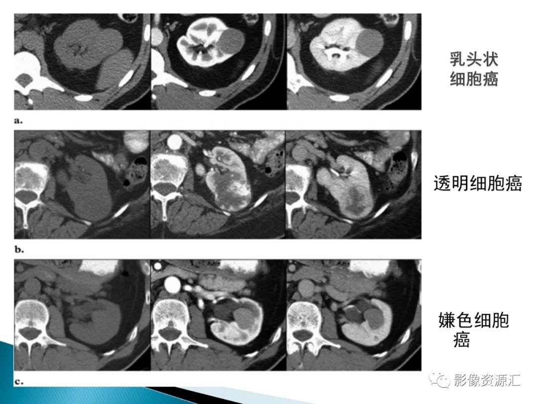 影像PPT - 【PPT】肾癌的CT MRI诊断-63