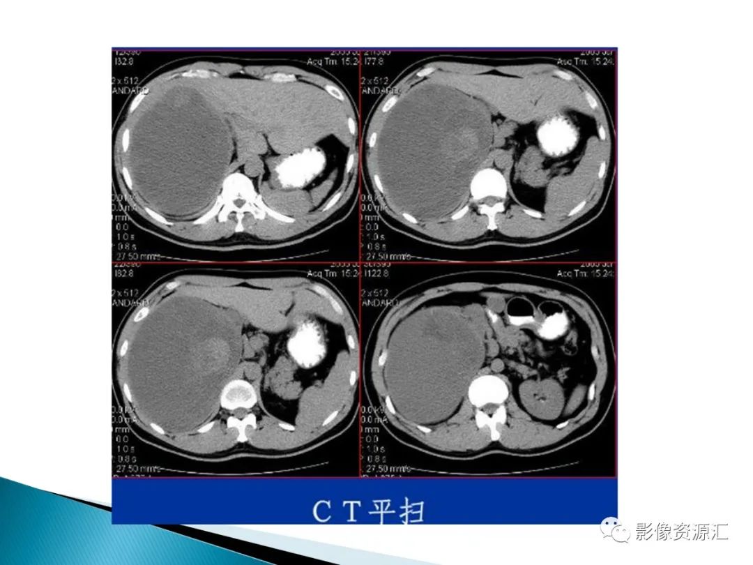 影像PPT - 【PPT】肾癌的CT MRI诊断-66