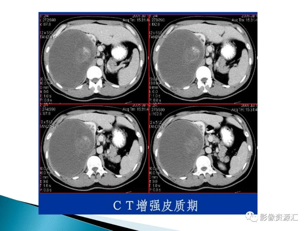 影像PPT - 【PPT】肾癌的CT MRI诊断-67