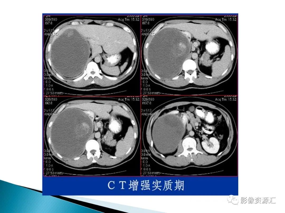 影像PPT - 【PPT】肾癌的CT MRI诊断-68