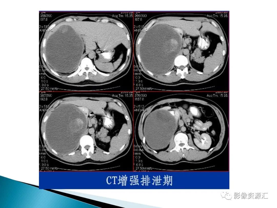 影像PPT - 【PPT】肾癌的CT MRI诊断-69