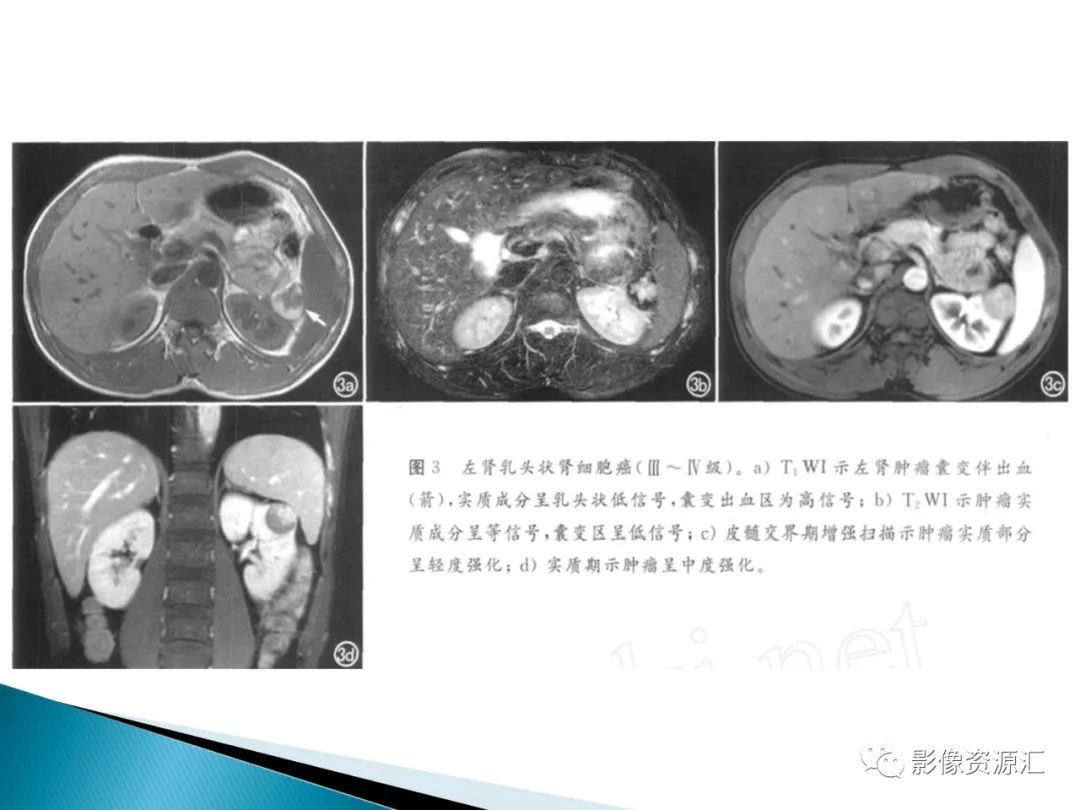 影像PPT - 【PPT】肾癌的CT MRI诊断-71