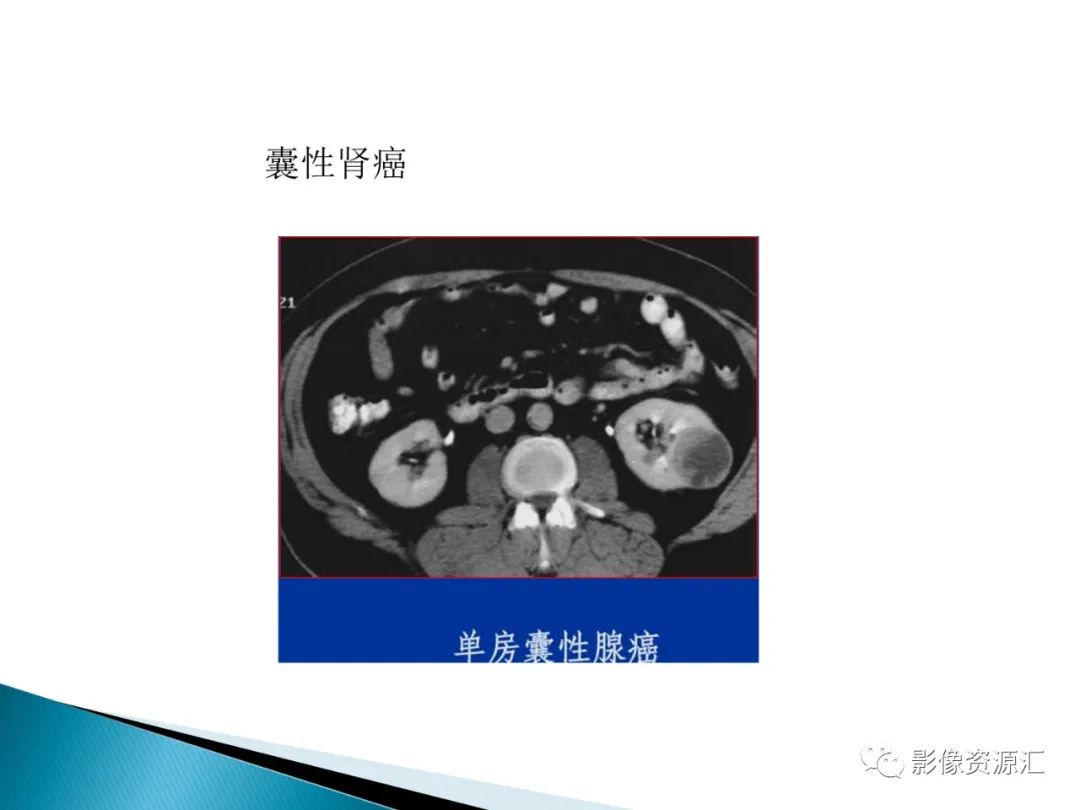 影像PPT - 【PPT】肾癌的CT MRI诊断-76