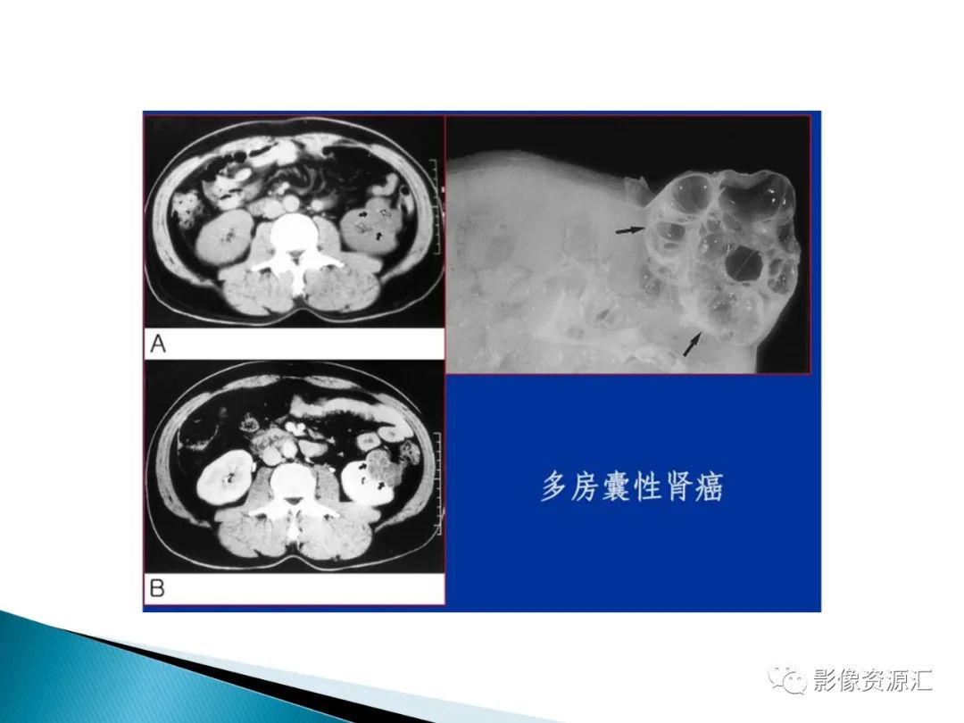 影像PPT - 【PPT】肾癌的CT MRI诊断-77