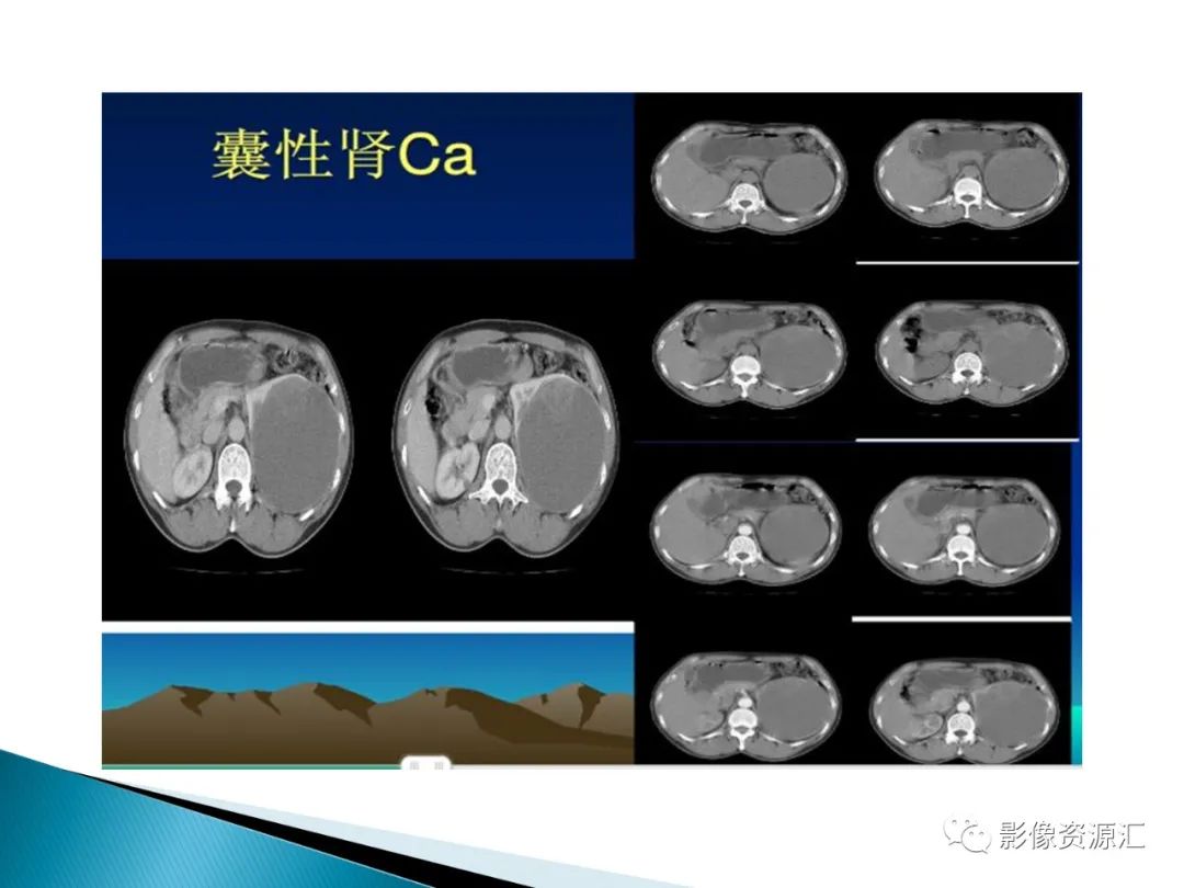 影像PPT - 【PPT】肾癌的CT MRI诊断-78