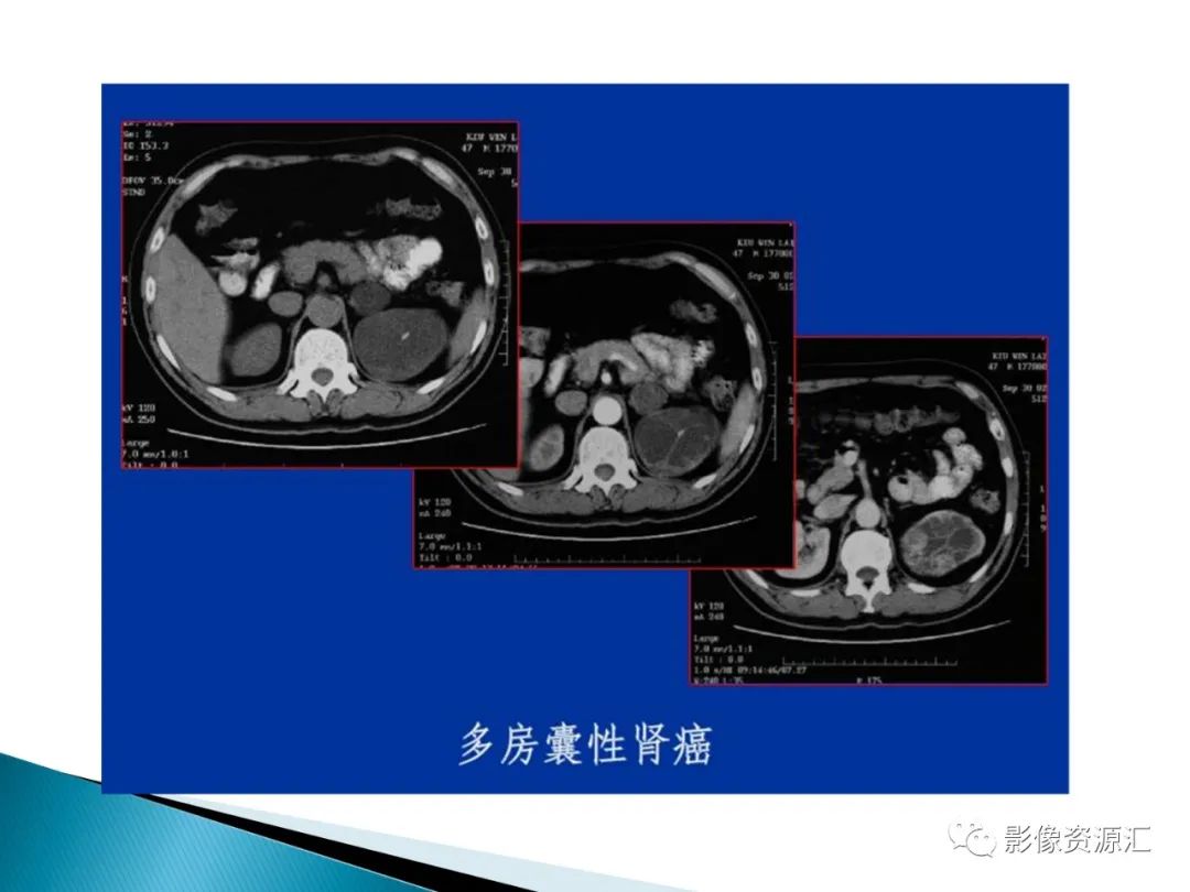 影像PPT - 【PPT】肾癌的CT MRI诊断-79
