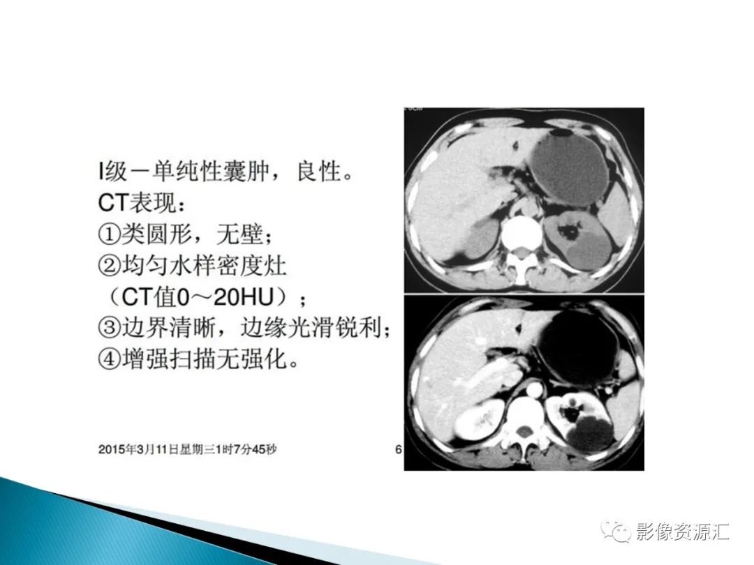 影像PPT - 【PPT】肾癌的CT MRI诊断-83