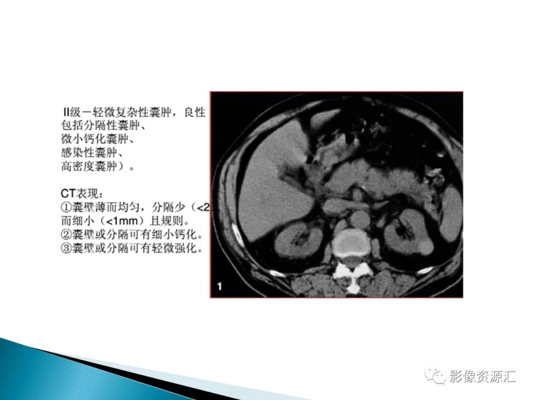 影像PPT - 【PPT】肾癌的CT MRI诊断-84