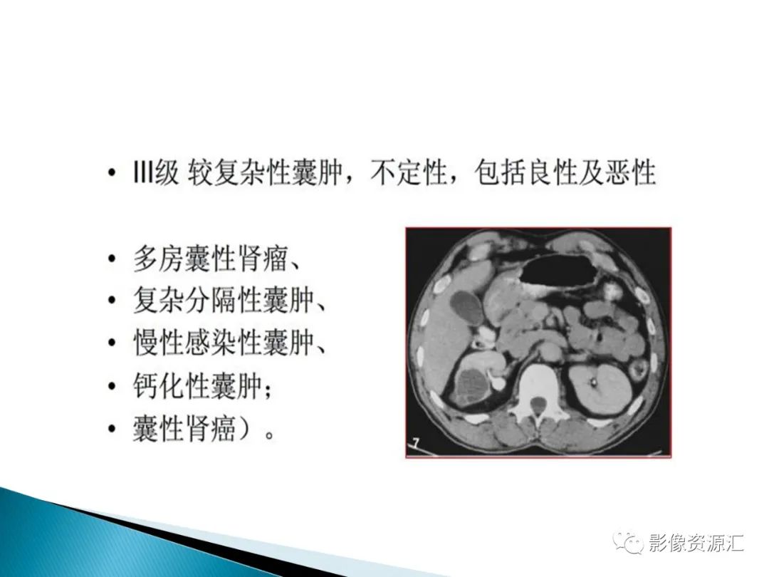 影像PPT - 【PPT】肾癌的CT MRI诊断-86