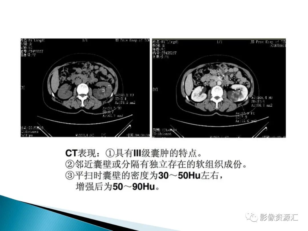 影像PPT - 【PPT】肾癌的CT MRI诊断-87
