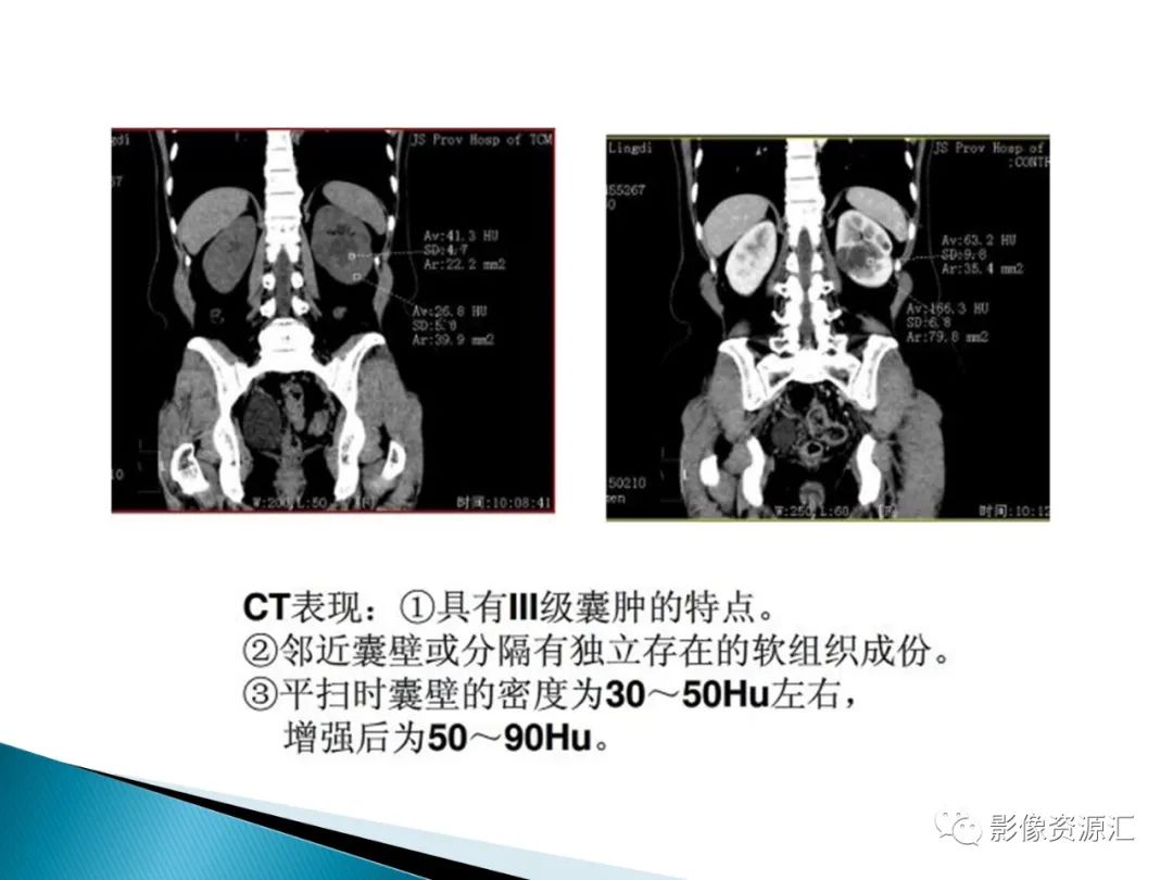 影像PPT - 【PPT】肾癌的CT MRI诊断-88