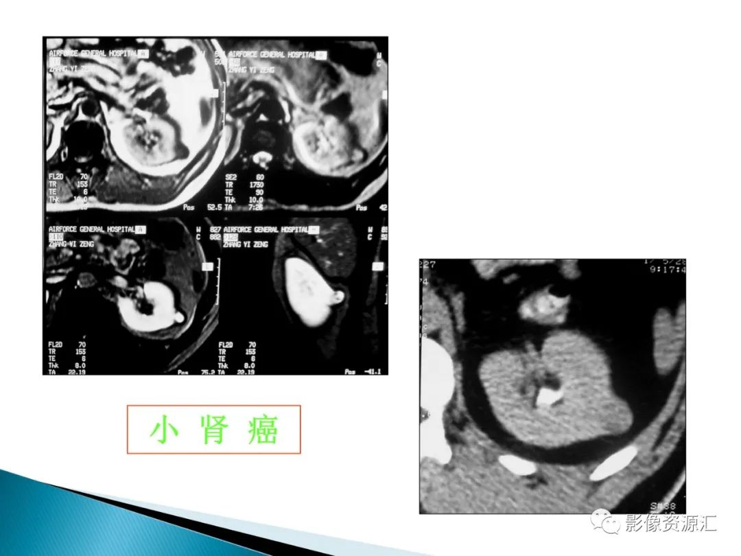 影像PPT - 【PPT】肾癌的CT MRI诊断-96