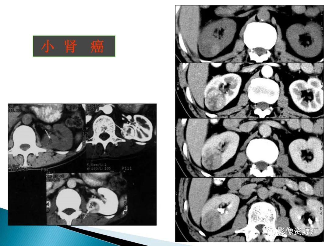 影像PPT - 【PPT】肾癌的CT MRI诊断-97