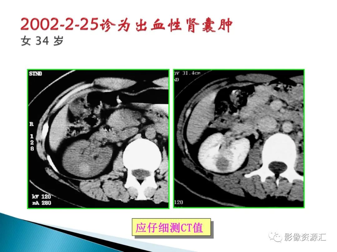 影像PPT - 【PPT】肾癌的CT MRI诊断-98