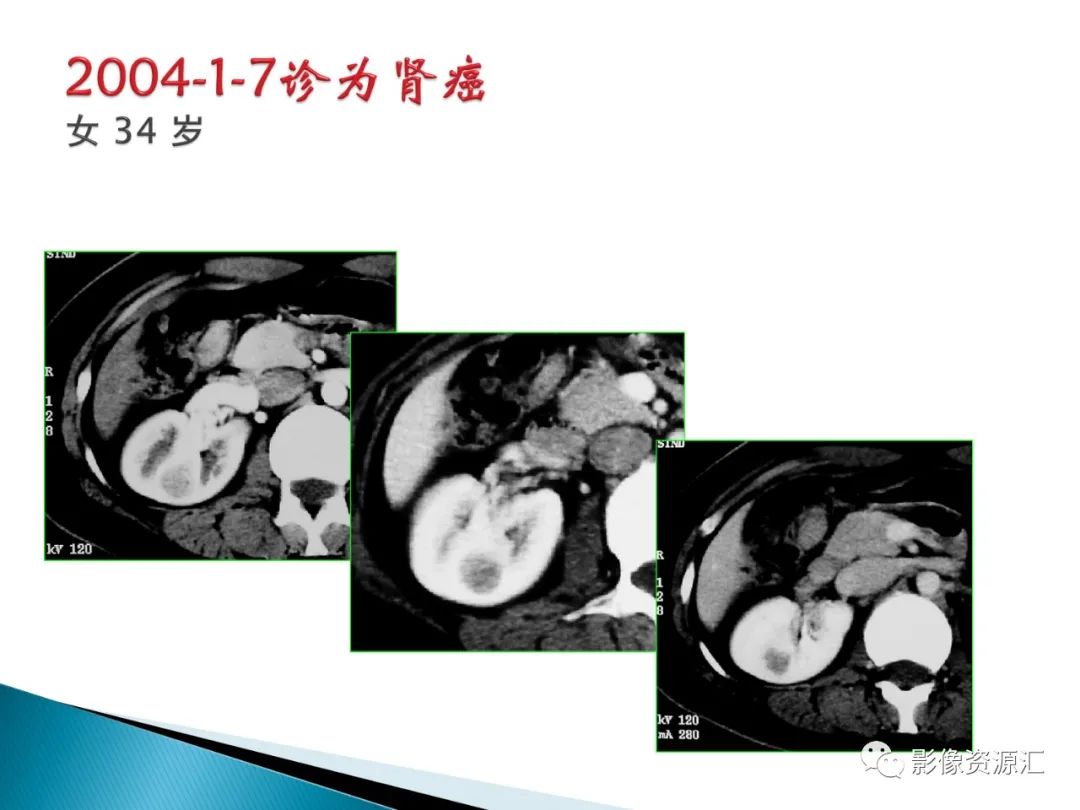 影像PPT - 【PPT】肾癌的CT MRI诊断-99
