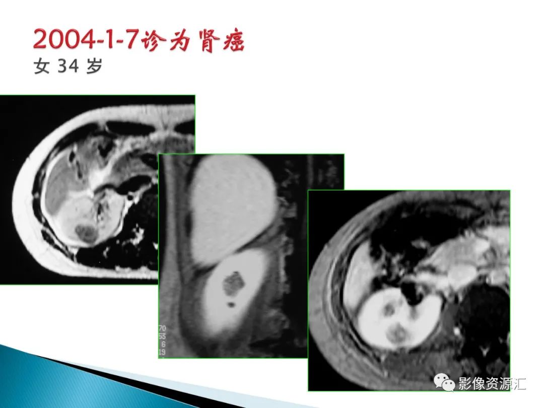 影像PPT - 【PPT】肾癌的CT MRI诊断-100