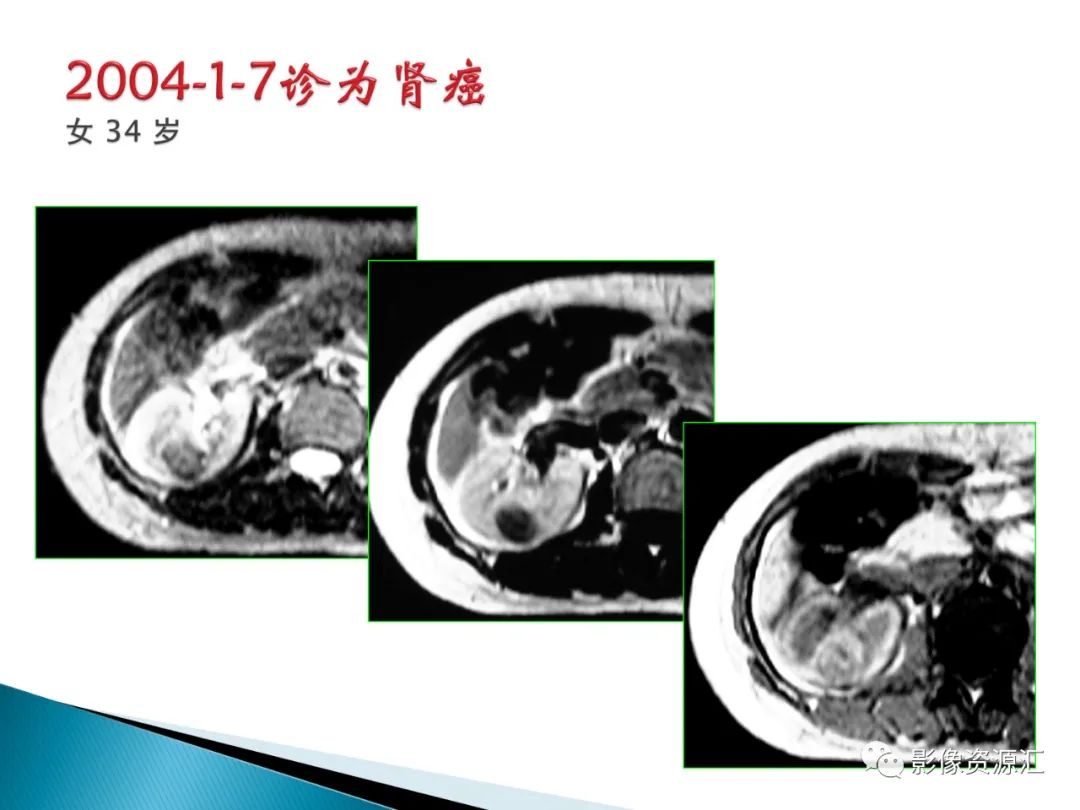 影像PPT - 【PPT】肾癌的CT MRI诊断-101