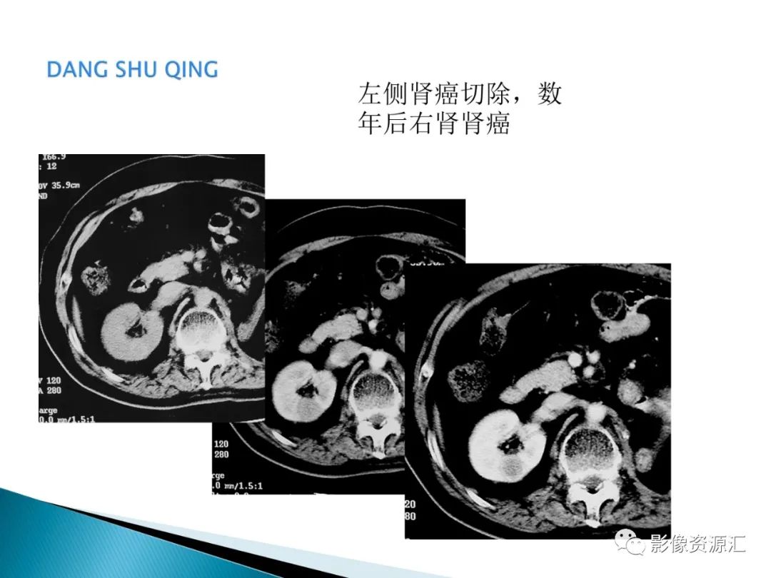 影像PPT - 【PPT】肾癌的CT MRI诊断-102