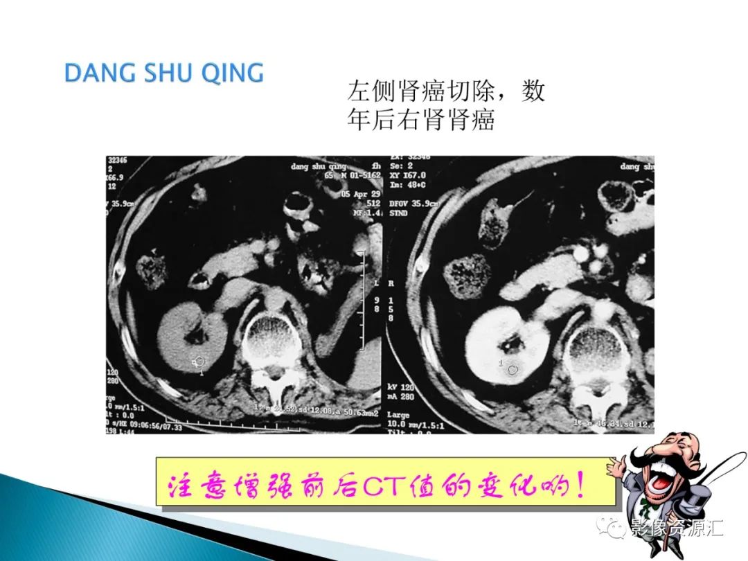 影像PPT - 【PPT】肾癌的CT MRI诊断-103