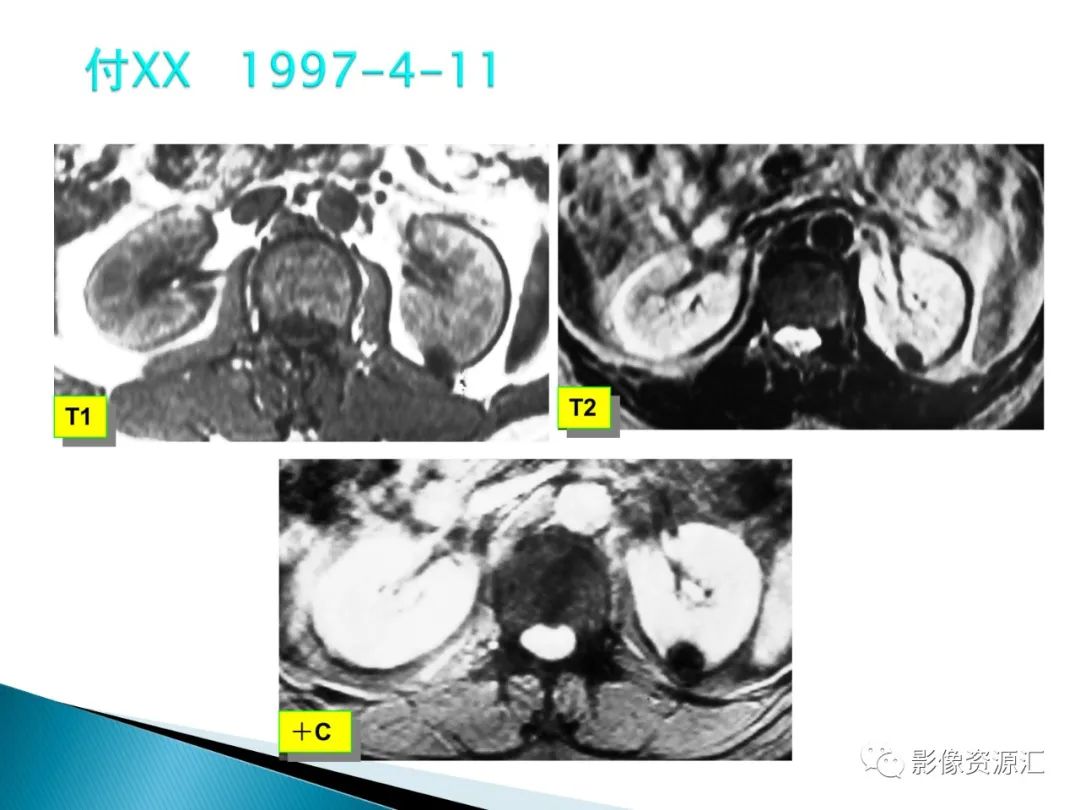 影像PPT - 【PPT】肾癌的CT MRI诊断-105