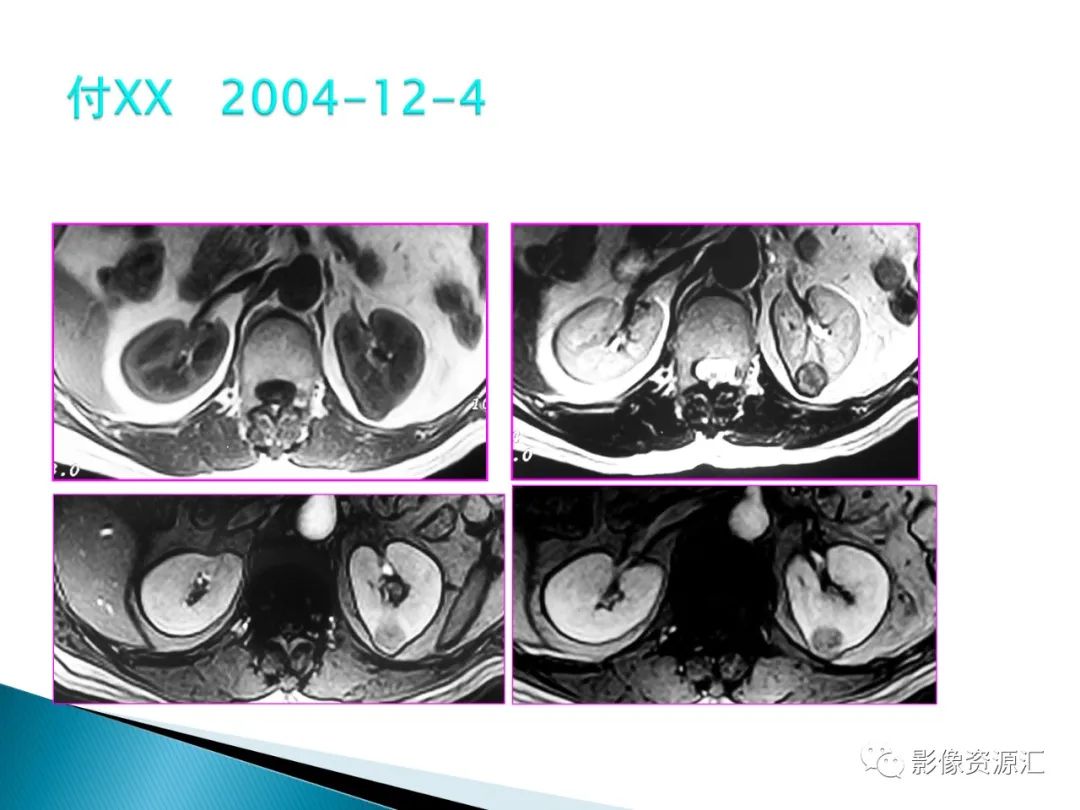 影像PPT - 【PPT】肾癌的CT MRI诊断-106