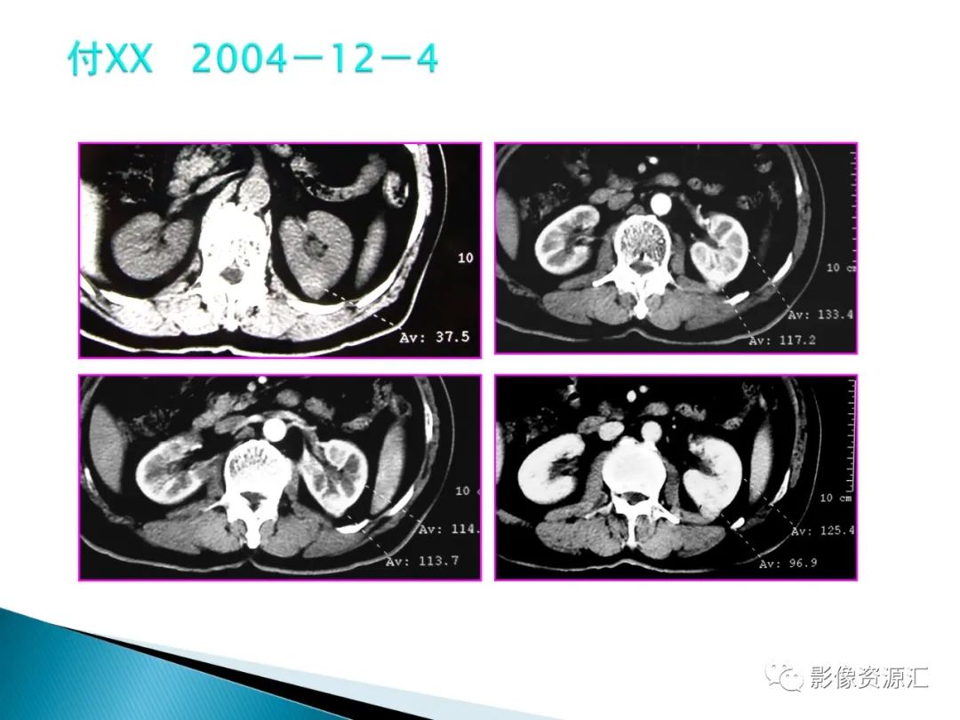 影像PPT - 【PPT】肾癌的CT MRI诊断-107