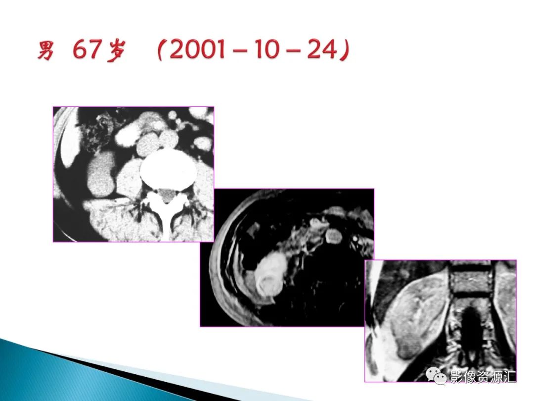 影像PPT - 【PPT】肾癌的CT MRI诊断-109
