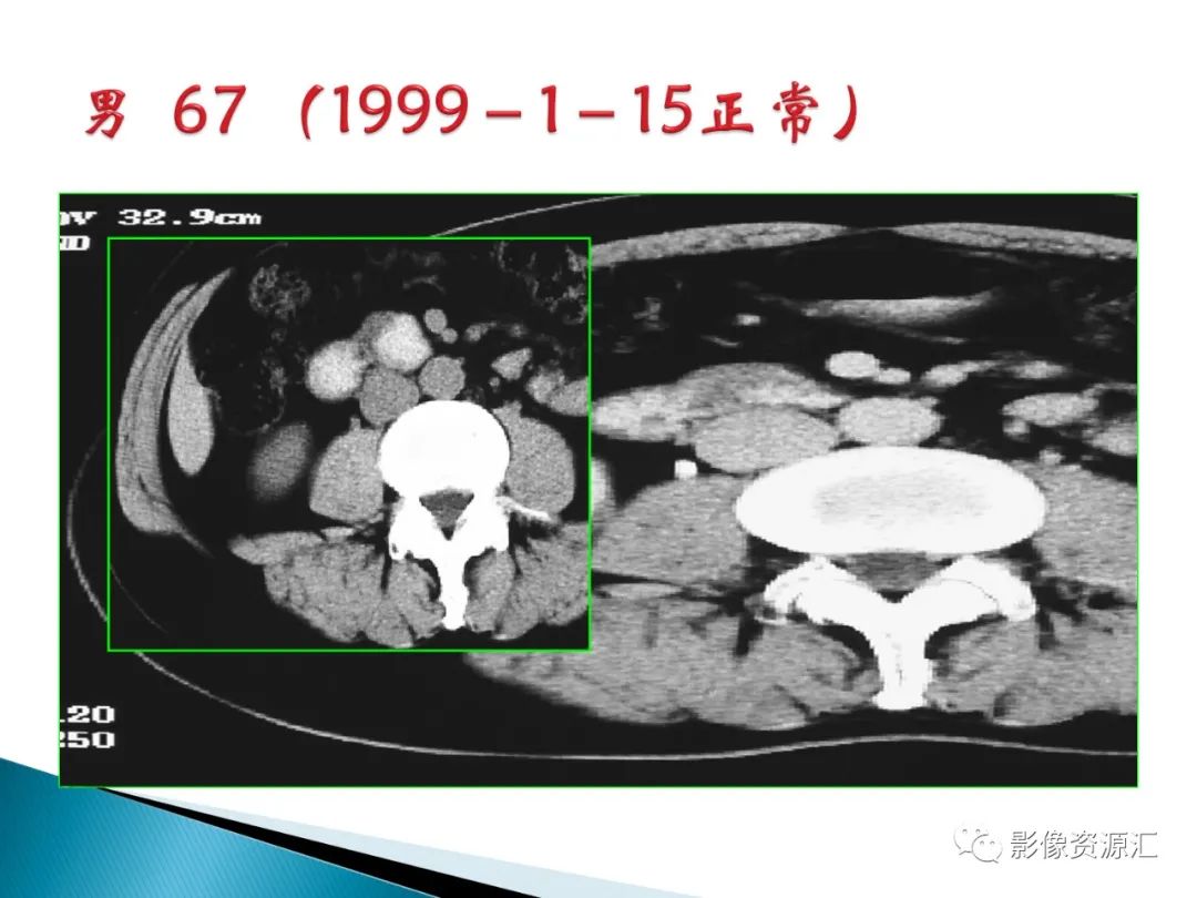 影像PPT - 【PPT】肾癌的CT MRI诊断-110