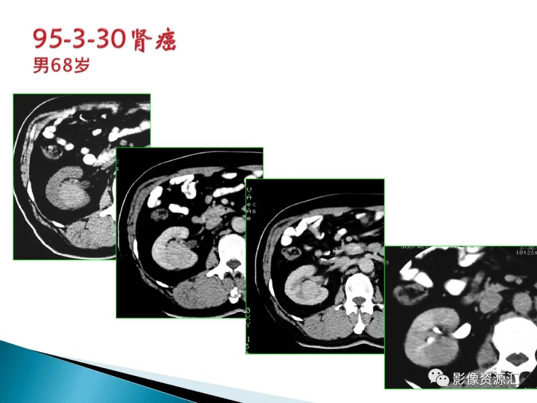 影像PPT - 【PPT】肾癌的CT MRI诊断-111