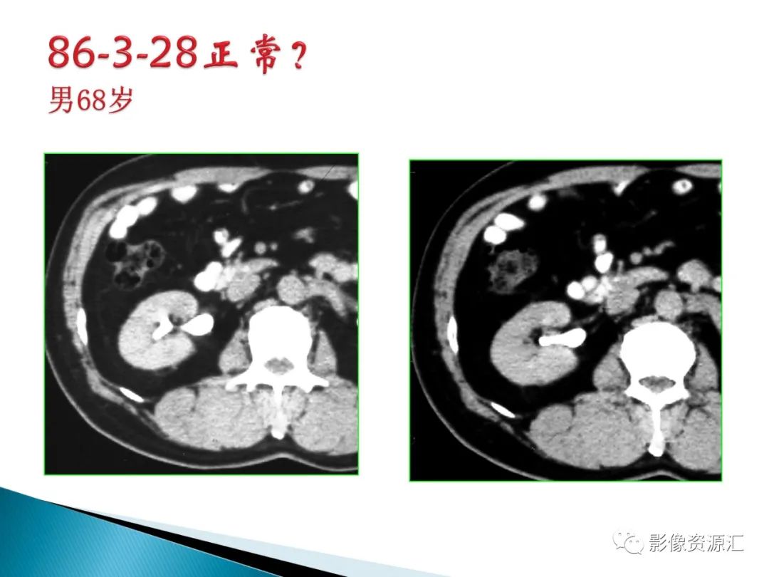 影像PPT - 【PPT】肾癌的CT MRI诊断-112