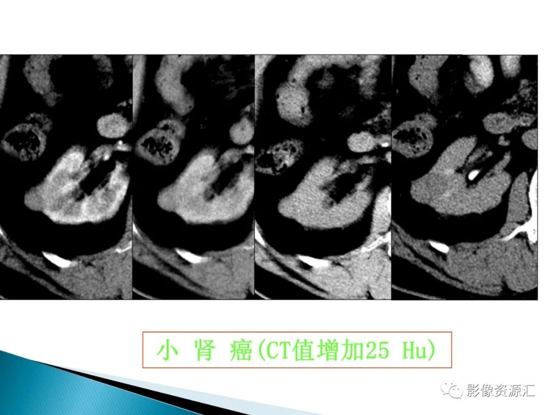 影像PPT - 【PPT】肾癌的CT MRI诊断-114