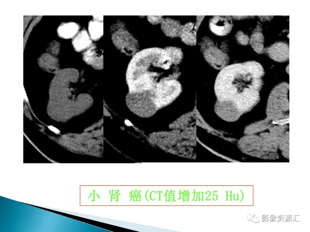 影像PPT - 【PPT】肾癌的CT MRI诊断-115