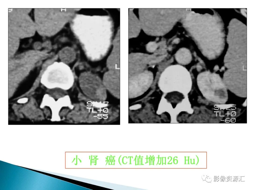 影像PPT - 【PPT】肾癌的CT MRI诊断-116