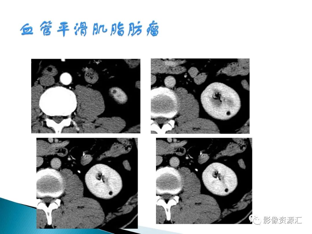 影像PPT - 【PPT】肾癌的CT MRI诊断-121