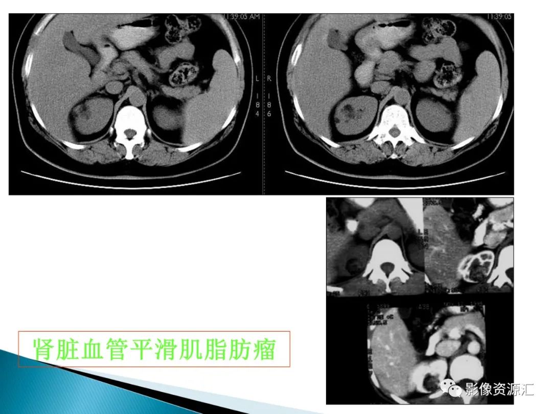 影像PPT - 【PPT】肾癌的CT MRI诊断-122
