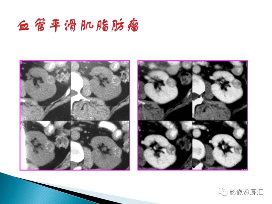 影像PPT - 【PPT】肾癌的CT MRI诊断-123