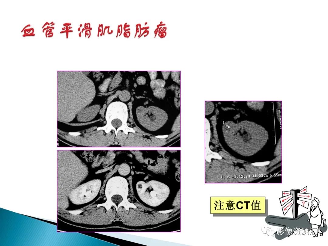 影像PPT - 【PPT】肾癌的CT MRI诊断-124