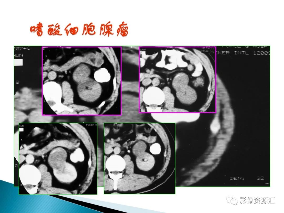 影像PPT - 【PPT】肾癌的CT MRI诊断-125