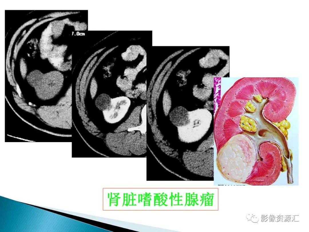 影像PPT - 【PPT】肾癌的CT MRI诊断-126