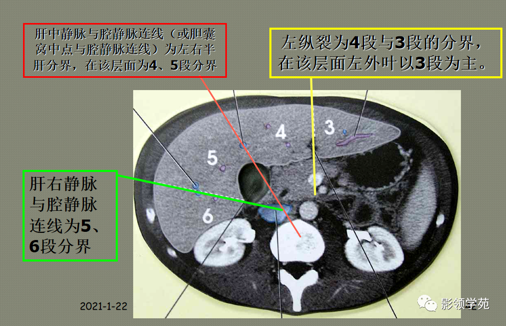 影像PPT - 肝脏的表面解剖及分叶分段-43