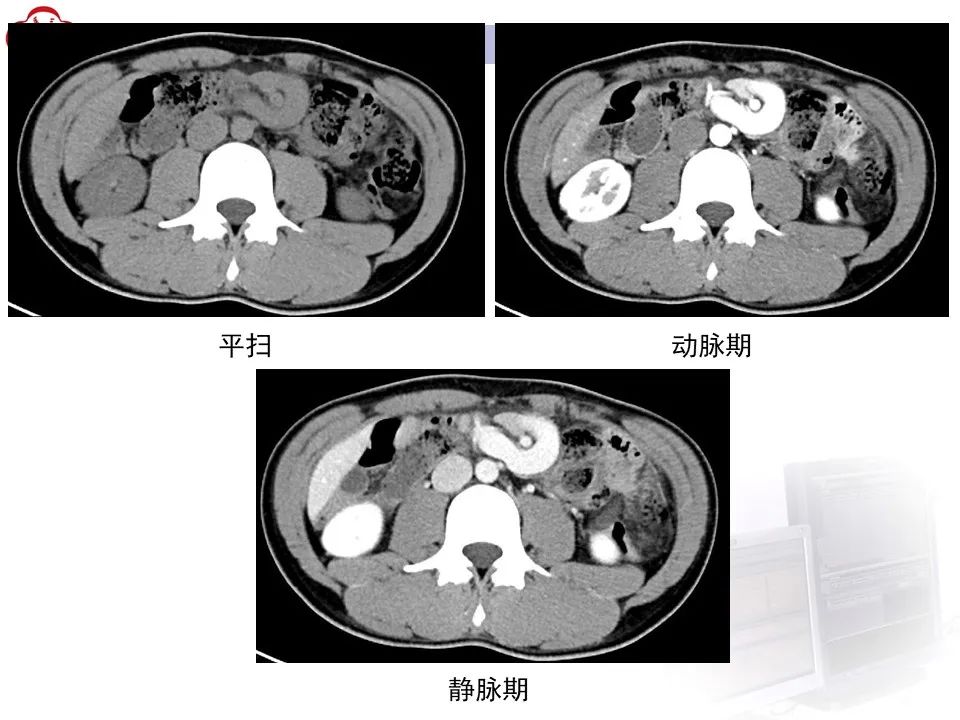 影像PPT - 【病例】肠旋转不良IM的影像-3