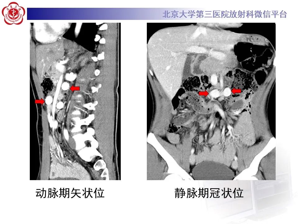 影像PPT - 【病例】肠旋转不良IM的影像-4