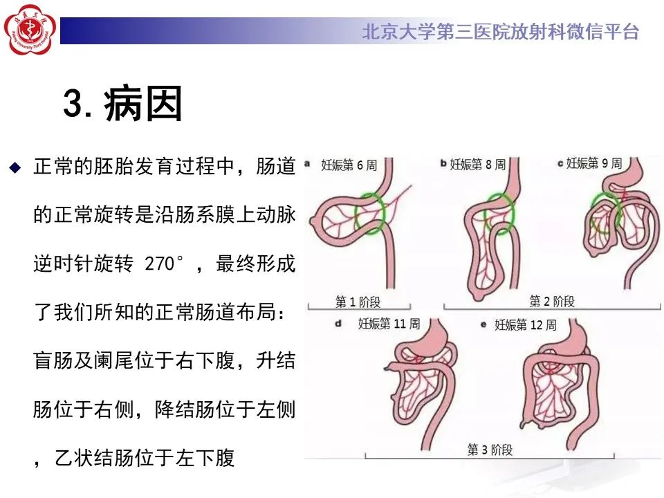 影像PPT - 【病例】肠旋转不良IM的影像-11