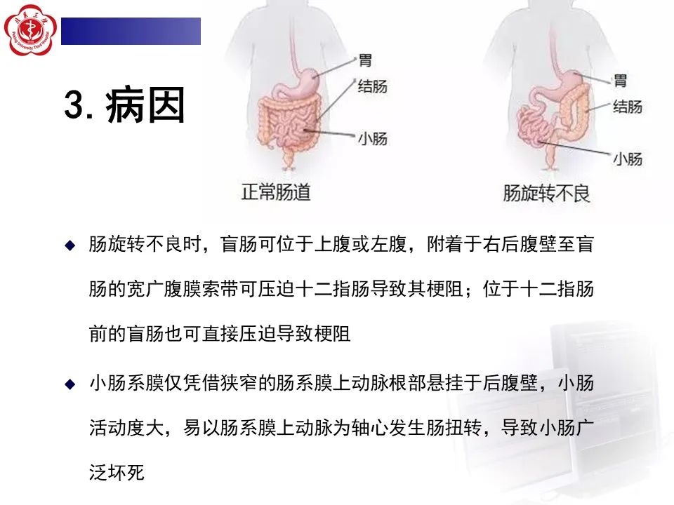 影像PPT - 【病例】肠旋转不良IM的影像-12