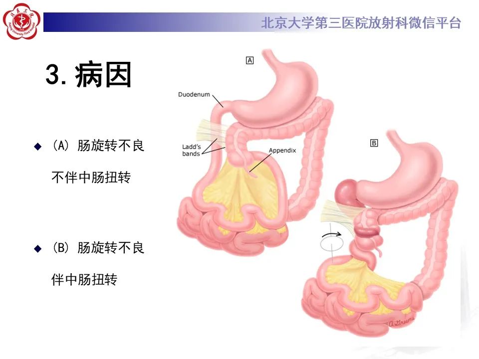 影像PPT - 【病例】肠旋转不良IM的影像-13