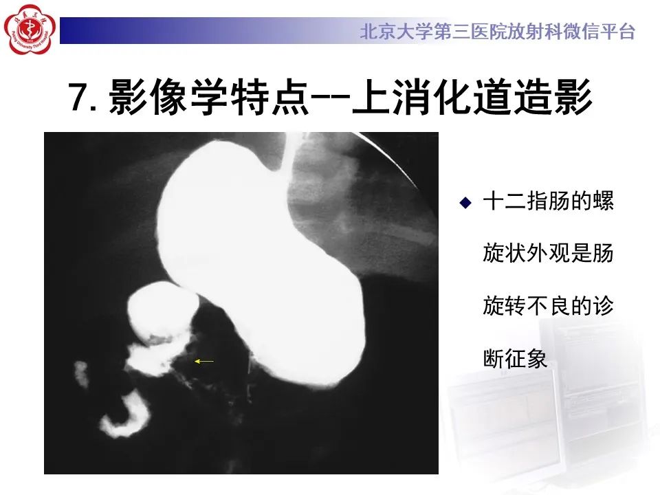 影像PPT - 【病例】肠旋转不良IM的影像-19