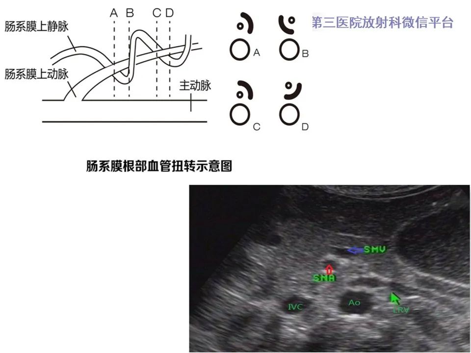 影像PPT - 【病例】肠旋转不良IM的影像-22