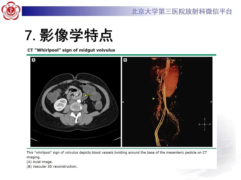 影像PPT - 【病例】肠旋转不良IM的影像-24