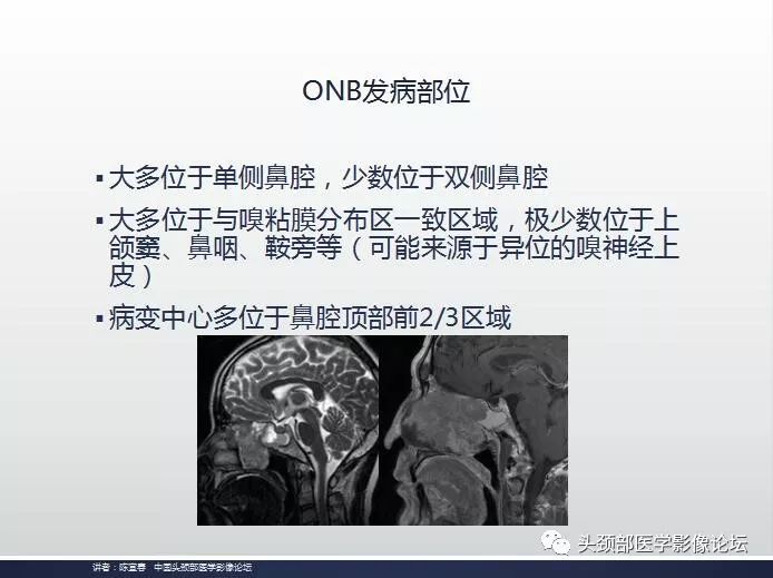 影像PPT - 嗅神经母细胞瘤影像学诊断分析思路-5